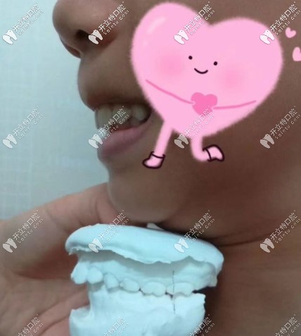 8岁女儿龅牙在常德武陵区口腔医院戴罗慕诱导矫正器1年了