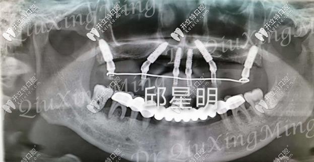 植入种植体的牙片