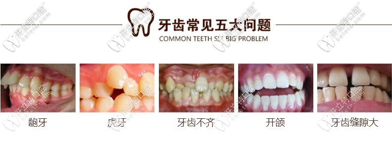 需要做矫正的各类牙齿畸形情况