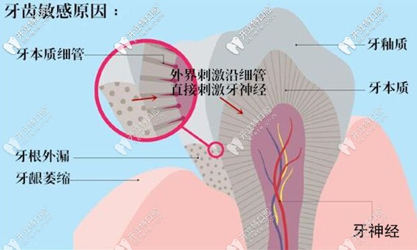 牙齿敏感的原因 牙齿敏感的原因
