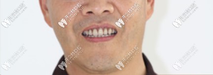 在昆明柏德口腔做完全口all-on-4种植牙5年后的照片