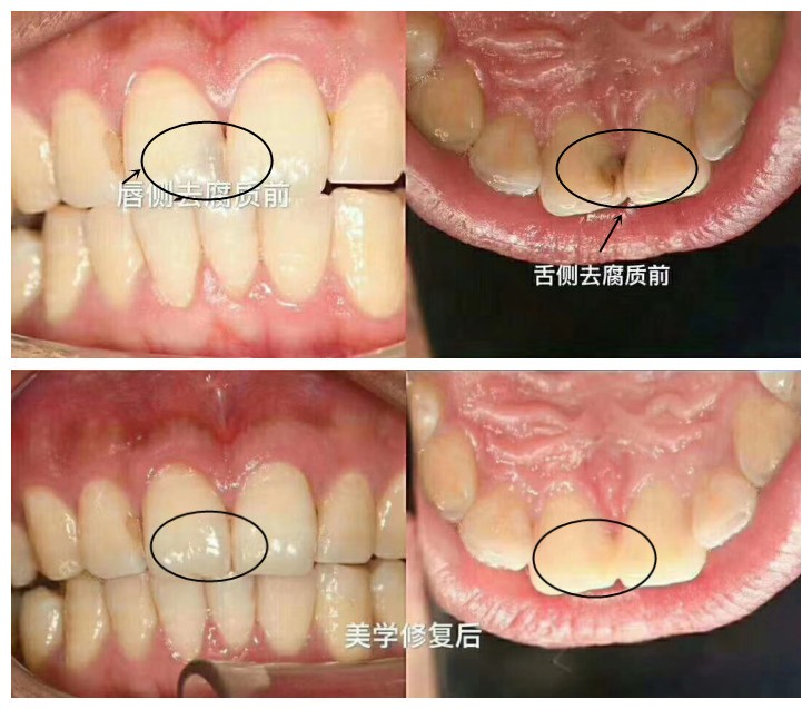 别再问嵌体补牙能用几年,这有全瓷嵌体使用1年后的效果反馈