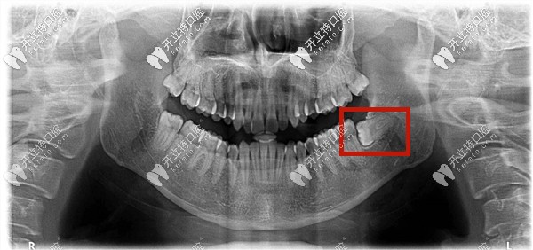 低位水平阻生齿图片