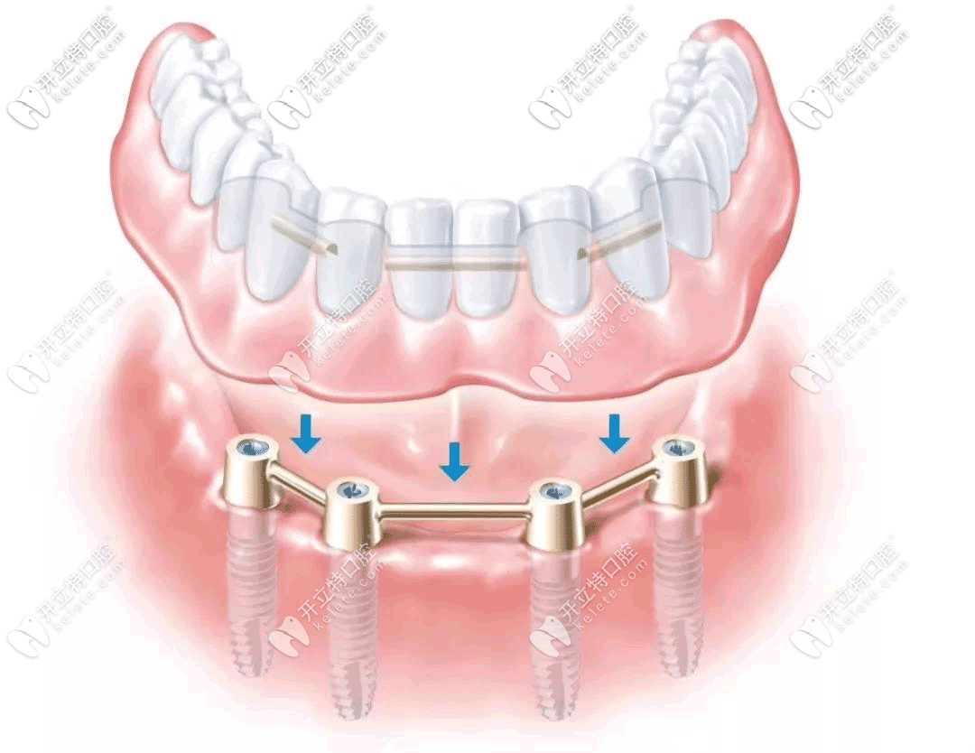 all-on-4种植牙