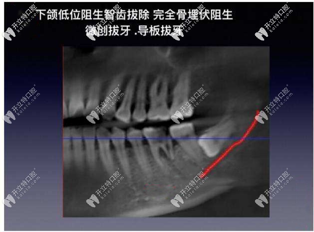 下颌低位阻生智齿图片