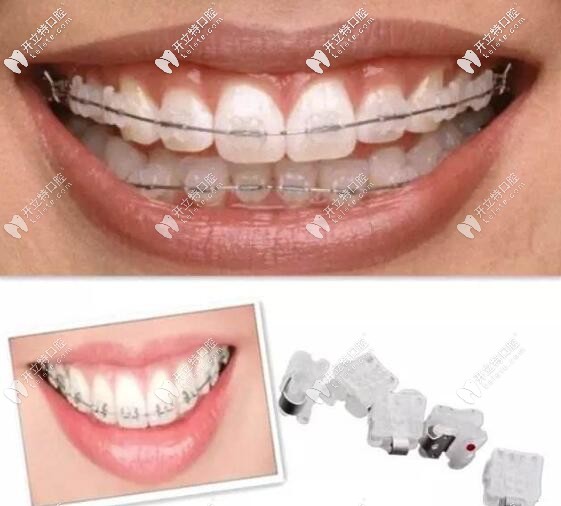 陶瓷自锁托槽牙套矫正 陶瓷自锁托槽牙套矫正
