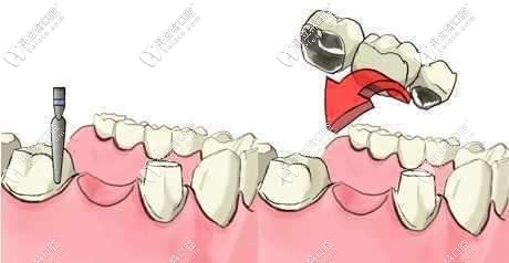 牙齿缺失适合做固定桥修复