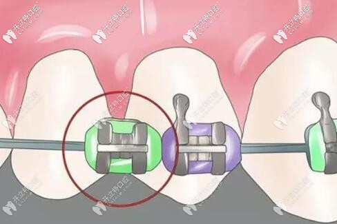 自锁托槽图片 自锁托槽图片