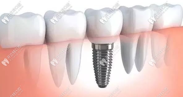种植牙