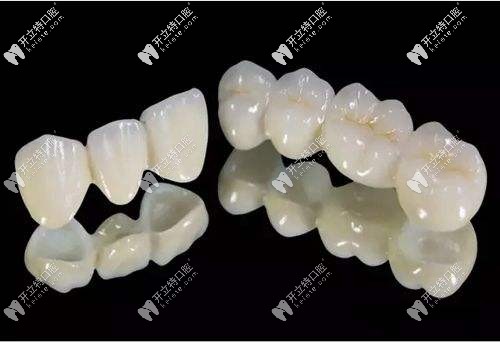 全瓷牙修复