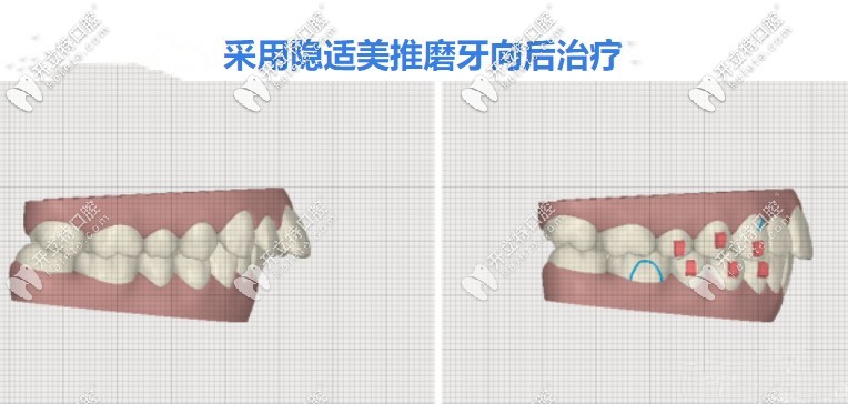 矫正龅牙隐形牙套快还是钢丝牙套快 矫正龅牙隐形牙套快还是钢丝牙套快