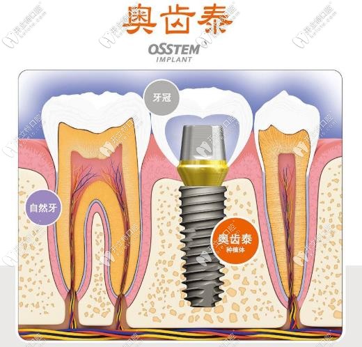 奥齿泰种植体