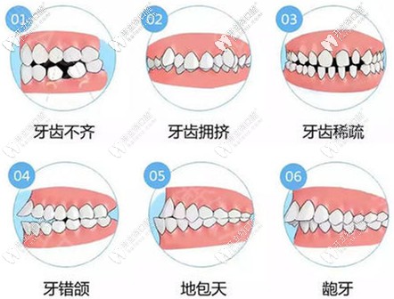 六种牙齿畸形的情况都适合做钢牙套