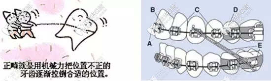 正畸中弓丝的种类有哪些