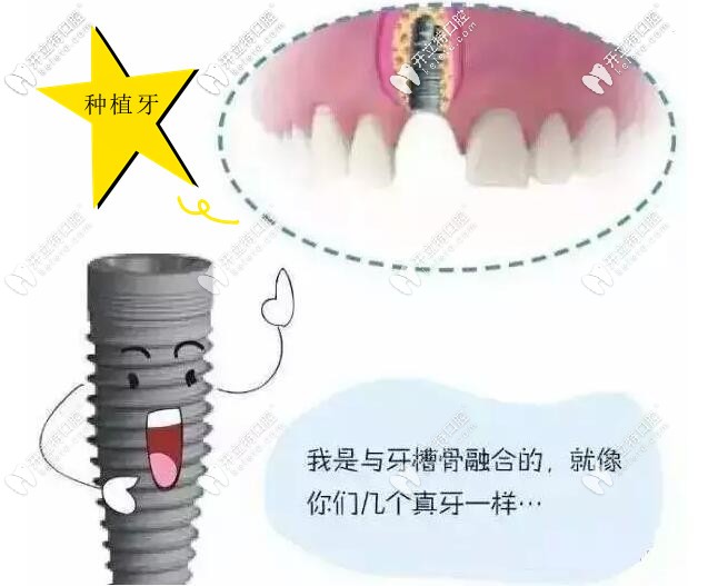 福州种植牙价格