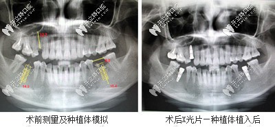 口内模拟种植