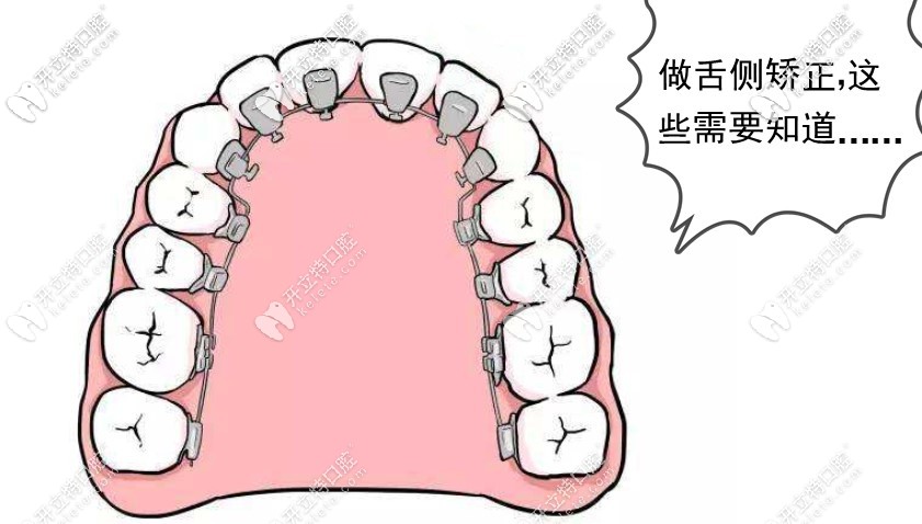 福州做舌侧矫正注意事项