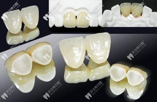 全瓷牙不易刺激牙龈和引起口腔组织的病变