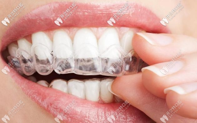 隐形透明牙套多少钱