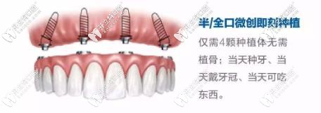 半口即刻种植牙 半口即刻种植牙