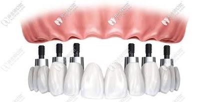 全口种植牙植入6颗植体 全口种植牙植入6颗植体