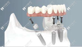全口种植体以倾斜角度植入 全口种植体以倾斜角度植入
