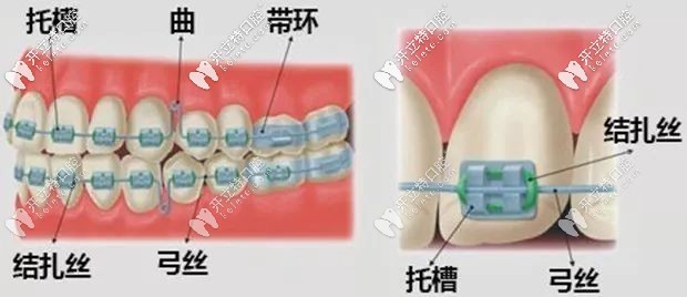 西安美奥口腔传统金属托槽牙齿矫正