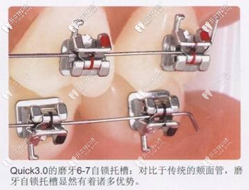 自锁式托槽矫正器