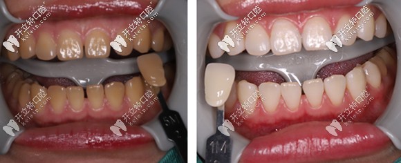 做完一个疗程的冷光美白,牙齿色号由5M赠白到1M 做完一个疗程的冷光美白,牙齿色号由5M赠白到1M