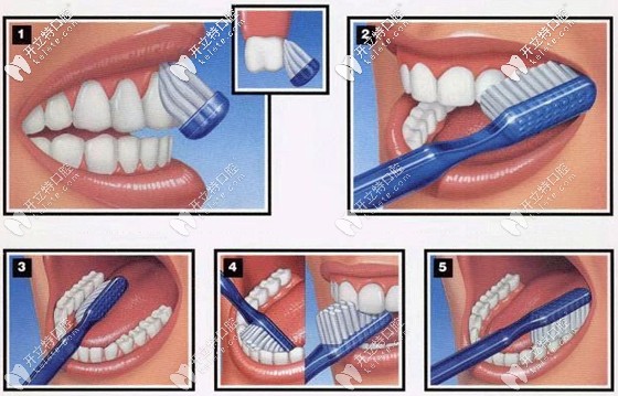 <!--<i data=20240703-sp></i>-->医生讲解巴氏刷牙法