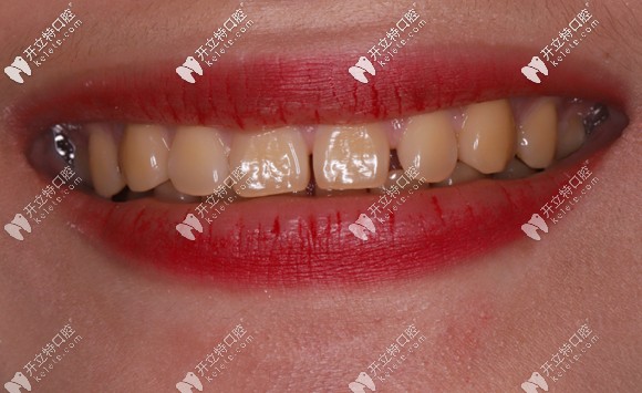 做牙齿美白前的一口大黄牙 做牙齿美白前的一口大黄牙