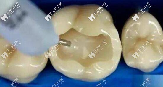 树脂补牙 树脂补牙