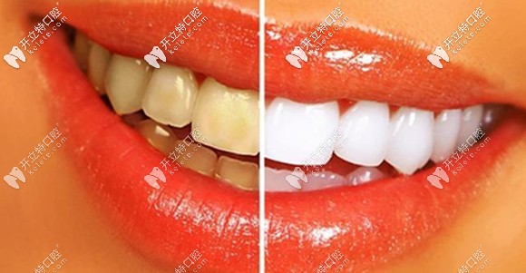 杨哲医生介绍瓷贴面修复的特色