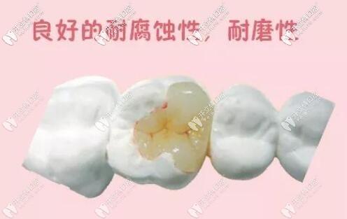 嵌体补牙 嵌体补牙