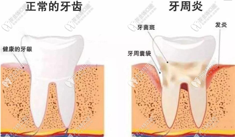 牙周炎的表现