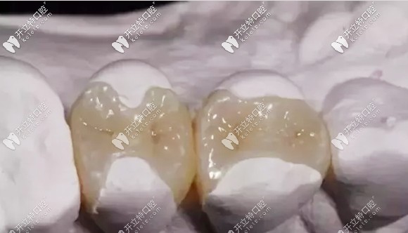 杨哲医生对瓷嵌体修复的介绍