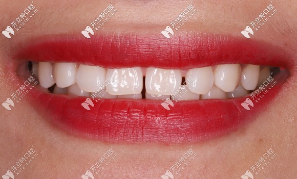 做美国beyond冷光美白后的效果图 做美国beyond冷光美白后的效果图