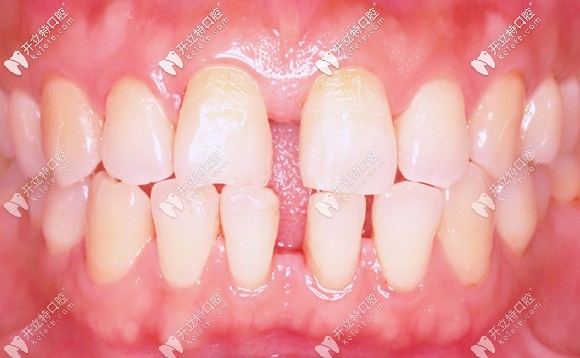 我关闭门牙缝隙前的照片