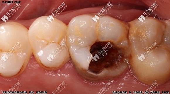 牙齿做铸瓷嵌体修复前的状况