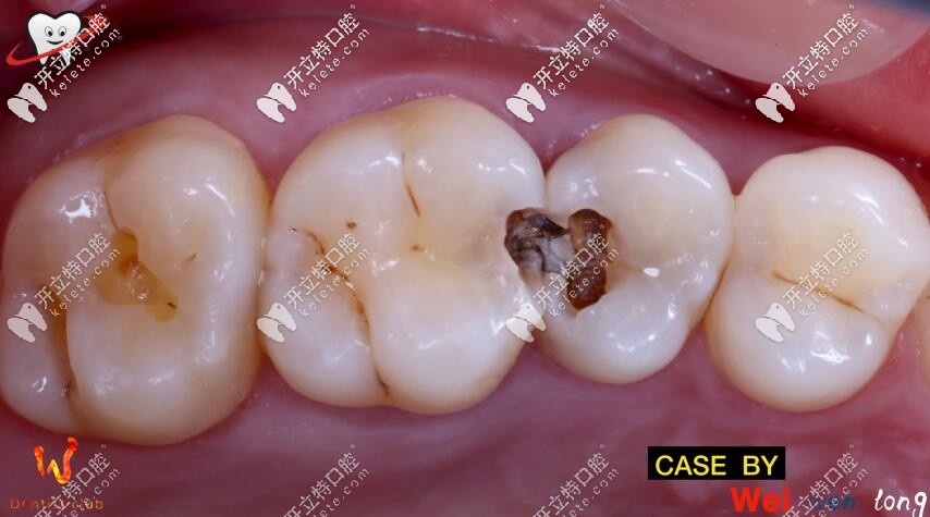 深龋选择了价格便宜的3m树脂补牙,其实还应该带个牙冠