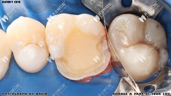 在做铸瓷嵌体修复前的树脂重建牙髓腔