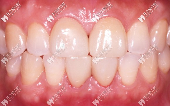 门牙刚做完瓷贴片后的效果