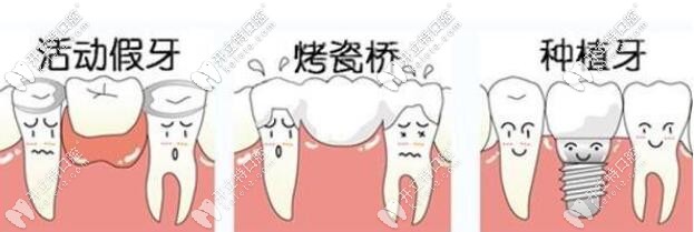 牙齿缺失修复方式