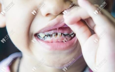 乳牙龋齿