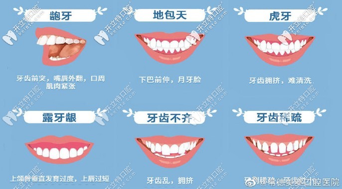 畸形的牙齿不仅仅影响脸型 畸形的牙齿不仅仅影响脸型