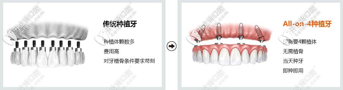 传统种植牙方式与all-on-4种植牙方式对比