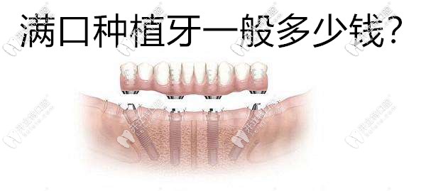 满口牙种植一般多少钱