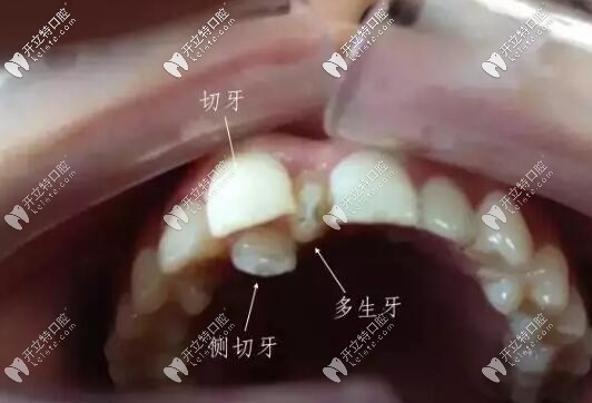 多生牙导致牙列拥挤 多生牙导致牙列拥挤