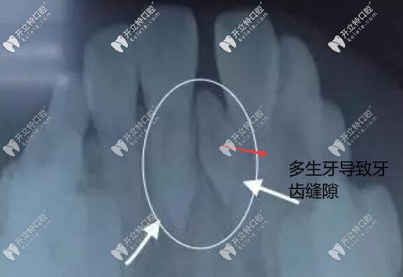 多生牙导致牙缝 多生牙导致牙缝