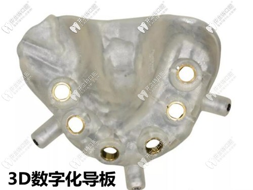 福州维乐口腔3D导板种植牙技术